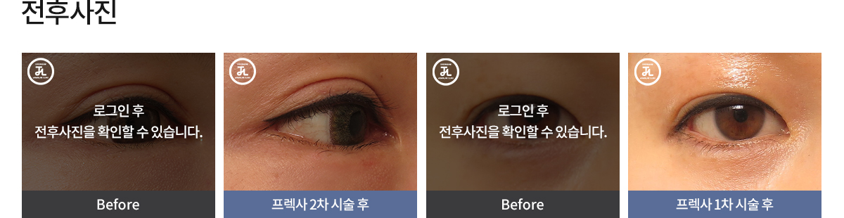 프렉사 전후사진 로그인전