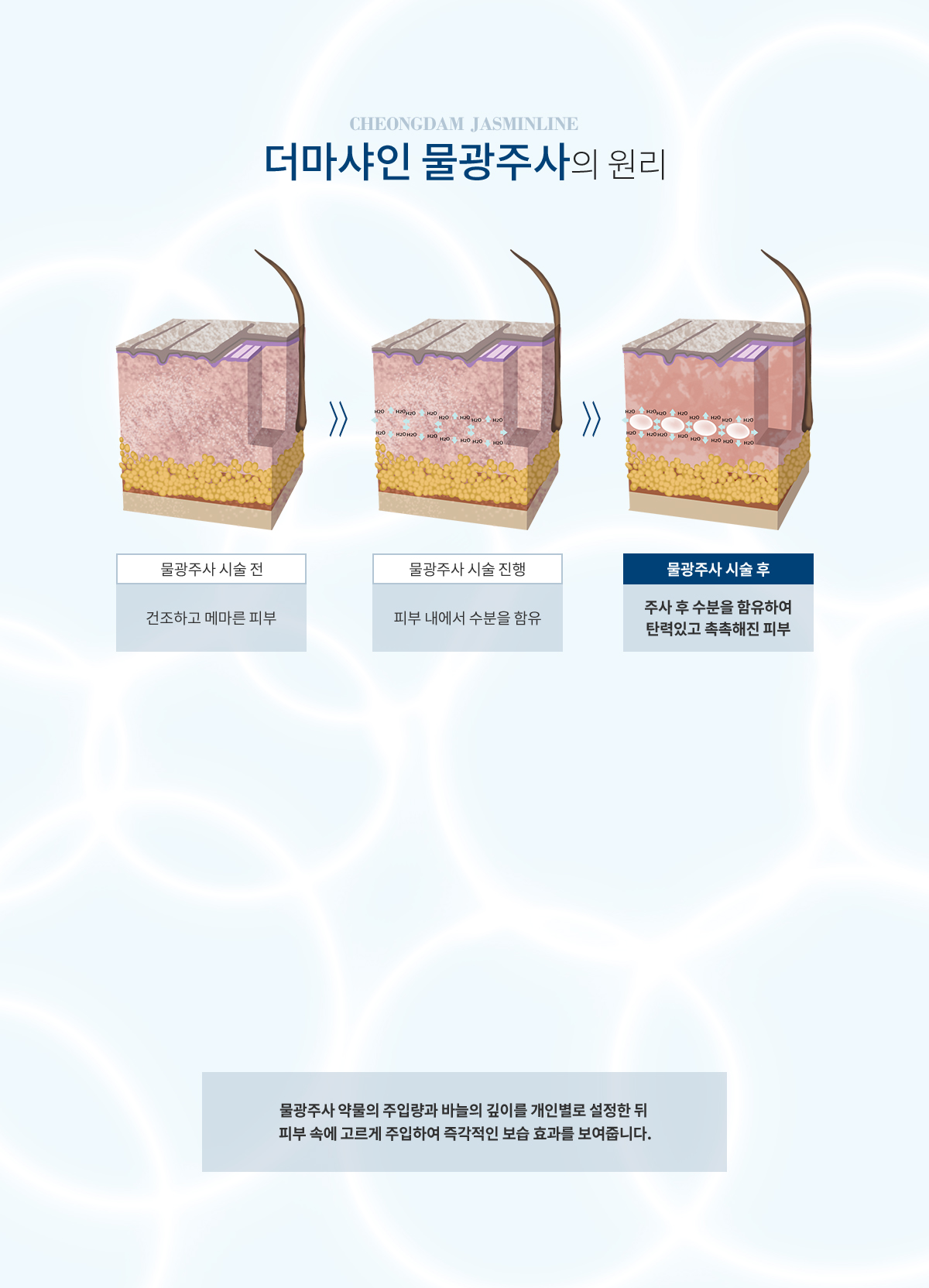 더마샤인 물광주사의 원리